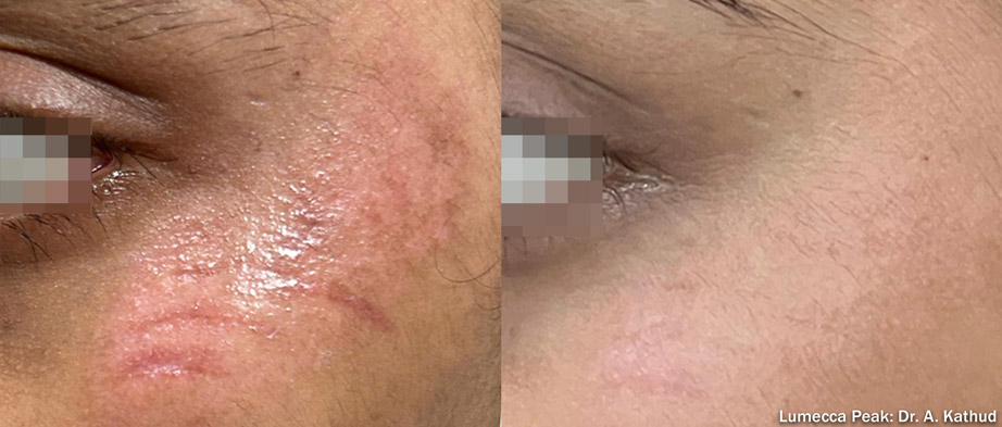 Before treatment