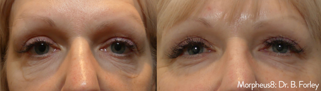 Before treatment