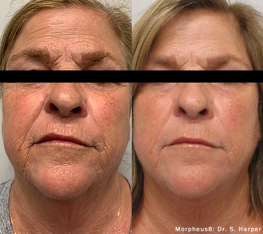 Before treatment
