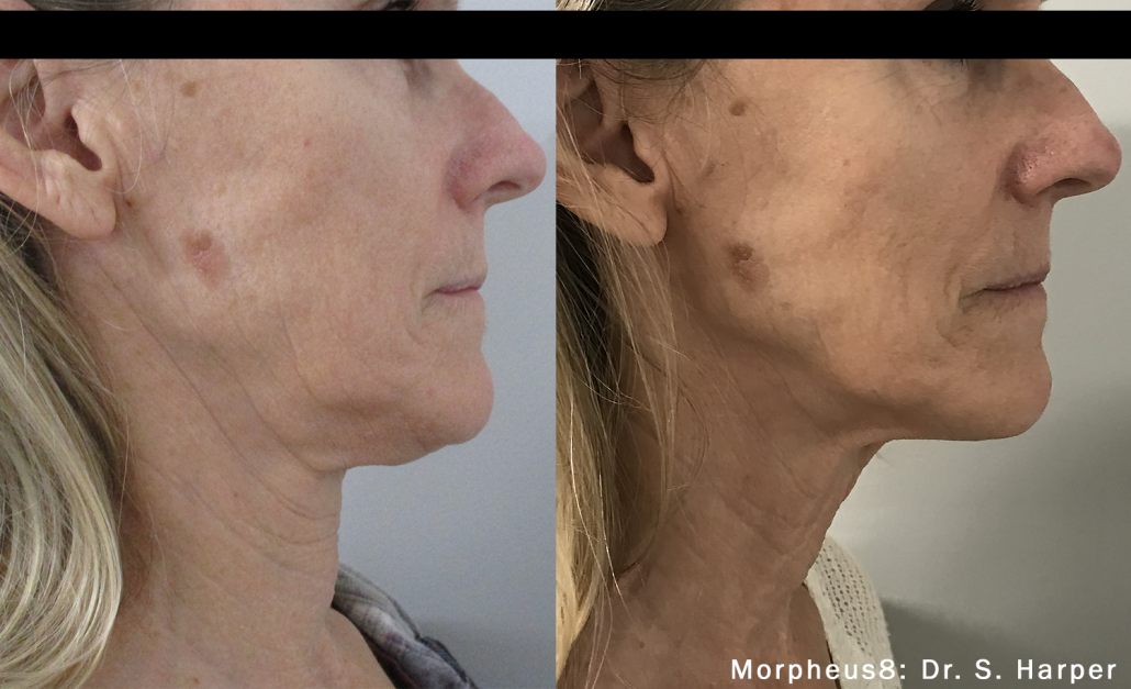 Before treatment